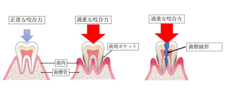 噛み合わせ