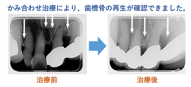 実際に歯を抜かずに済んだ症例